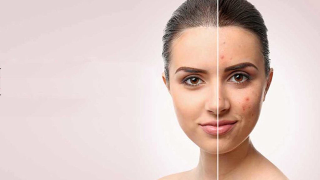 Before and After of Laser Acne Treatment